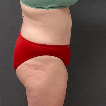 Abdominoplasty Before & After Patient #15924
