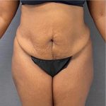 Abdominoplasty Before & After Patient #15925