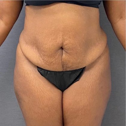 Abdominoplasty Before & After Patient #15925