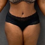 Abdominoplasty Before & After Patient #15925
