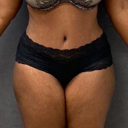 Abdominoplasty Before & After Patient #15925