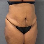 Abdominoplasty Before & After Patient #15925