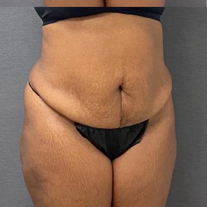 Abdominoplasty Before & After Patient #15925