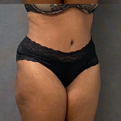 Abdominoplasty Before & After Patient #15925