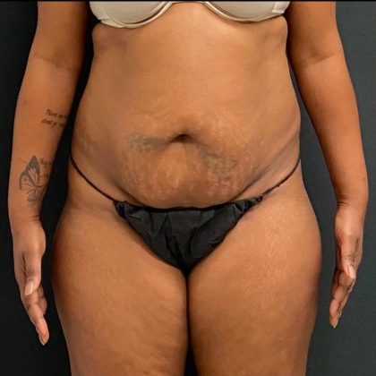 Abdominoplasty Before & After Patient #15926