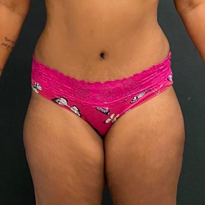 Abdominoplasty Before & After Patient #15926