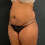 Abdominoplasty Before & After Patient #15926