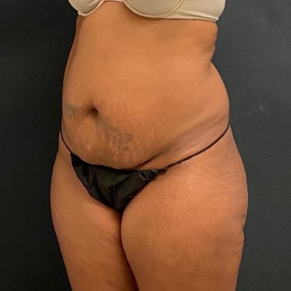 Abdominoplasty Before & After Patient #15926