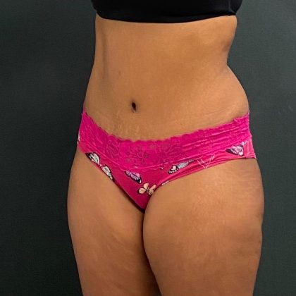 Abdominoplasty Before & After Patient #15926