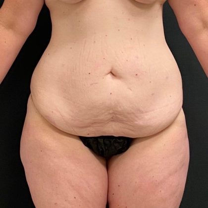 Abdominoplasty Before & After Patient #15927