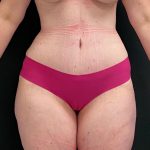 Abdominoplasty Before & After Patient #15927