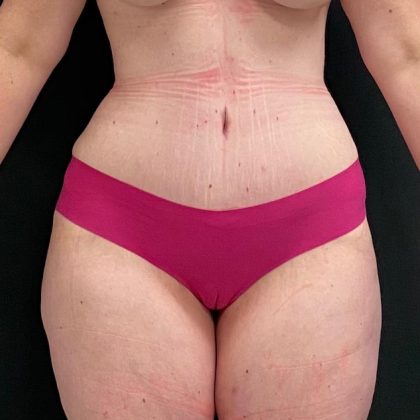 Abdominoplasty Before & After Patient #15927