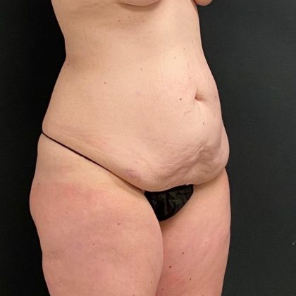 Abdominoplasty Before & After Patient #15927