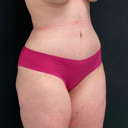 Abdominoplasty Before & After Patient #15927