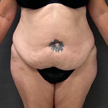 Abdominoplasty Before & After Patient #15928
