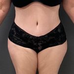 Abdominoplasty Before & After Patient #15928