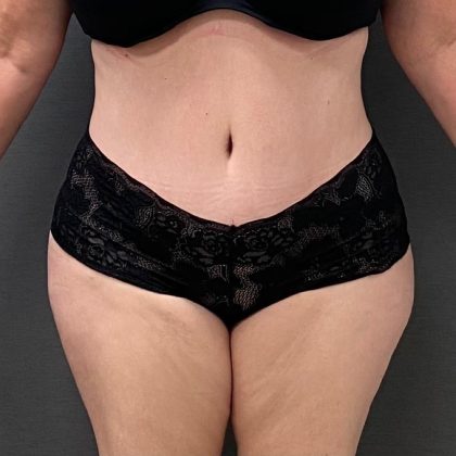 Abdominoplasty Before & After Patient #15928
