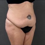 Abdominoplasty Before & After Patient #15928