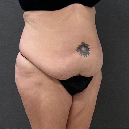 Abdominoplasty Before & After Patient #15928
