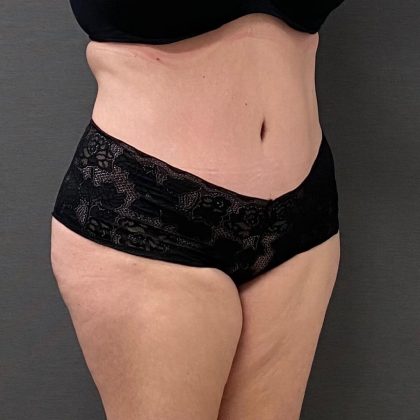 Abdominoplasty Before & After Patient #15928