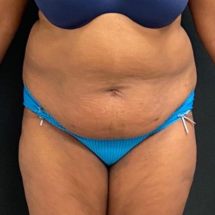 Abdominoplasty Before & After Patient #15929