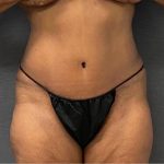 Abdominoplasty Before & After Patient #15929