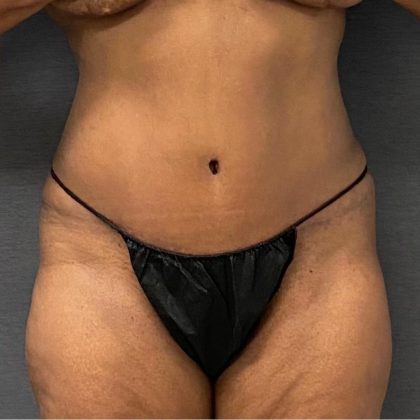 Abdominoplasty Before & After Patient #15929