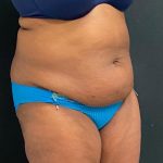 Abdominoplasty Before & After Patient #15929
