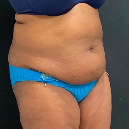 Abdominoplasty Before & After Patient #15929