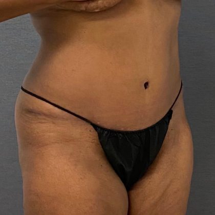 Abdominoplasty Before & After Patient #15929