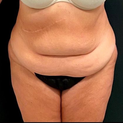 Abdominoplasty Before & After Patient #15930
