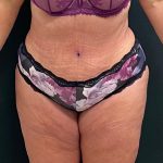 Abdominoplasty Before & After Patient #15930