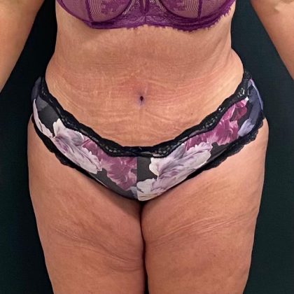 Abdominoplasty Before & After Patient #15930