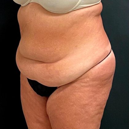 Abdominoplasty Before & After Patient #15930