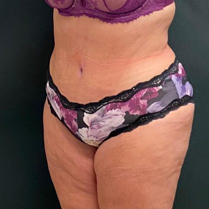 Abdominoplasty Before & After Patient #15930
