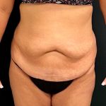 Abdominoplasty Before & After Patient #15931