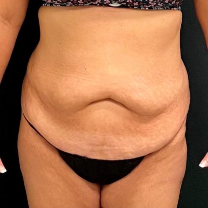 Abdominoplasty Before & After Patient #15931