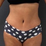 Abdominoplasty Before & After Patient #15931