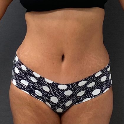Abdominoplasty Before & After Patient #15931