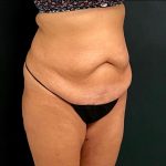 Abdominoplasty Before & After Patient #15931
