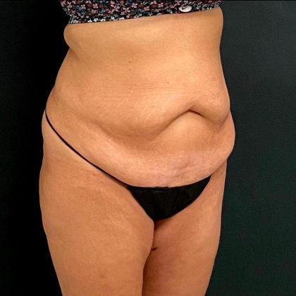 Abdominoplasty Before & After Patient #15931