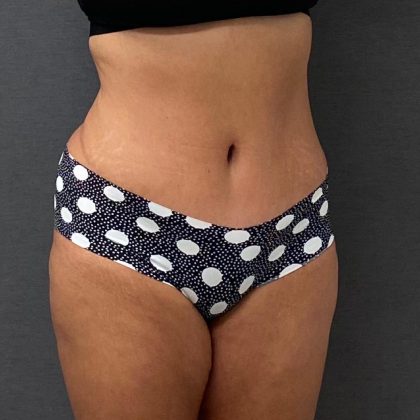 Abdominoplasty Before & After Patient #15931