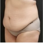Abdominoplasty Before & After Patient #15906