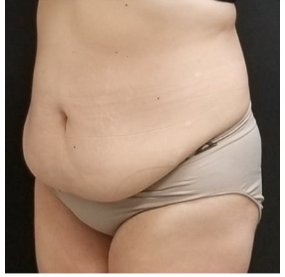 Abdominoplasty Before & After Patient #15906