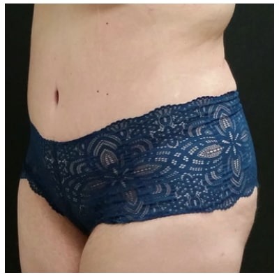 Abdominoplasty Before & After Patient #15906