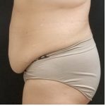 Abdominoplasty Before & After Patient #15906