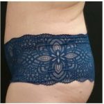 Abdominoplasty Before & After Patient #15906