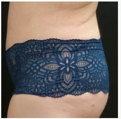 Abdominoplasty Before & After Patient #15906