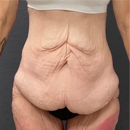 Abdominoplasty Before & After Patient #15933