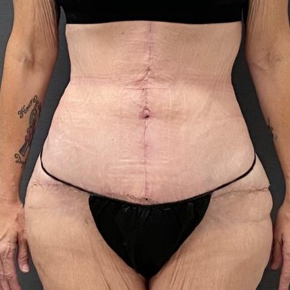 Abdominoplasty Before & After Patient #15933